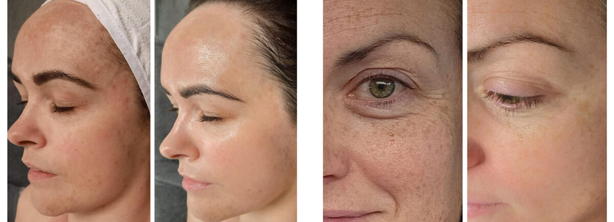 No one understands hyperpigmentation as much as the Koreans, and their products are well known around the world to produce glass, porcelain results,” says Marsha Abrahams, distributor of the Storyderm Dermatology Skincare line. Pictured are before and after treatment images using the Storyderm O2 White line.